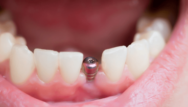 Ile kosztują implanty zębowe